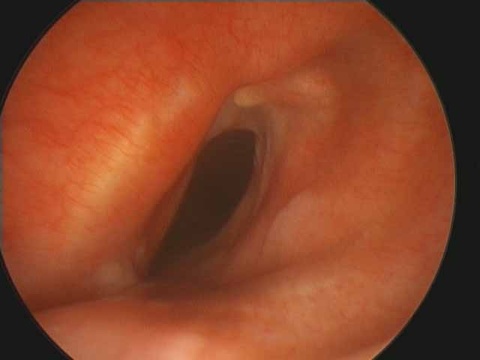 Microdirect laryngoscopy with long 0 degree scope shows scarring anteriorly drawing lateral walls medially