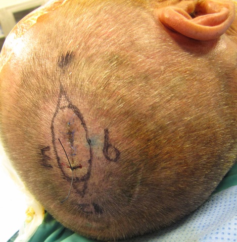 1 cm margins about T1b melanoma oriented with suture at 12:00. Note region (at 9:00) of 0.5 cc of dermal injection of methylene blue.