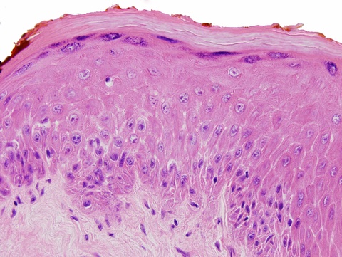 This mucosa shows budding along the mucosa/submucosal junction with mild cytologic atypia and nuclear hyperchromatism confined to the basal third warranting a diagnosis of mild dysplasia.