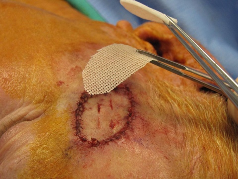    Full thickness skin graft secured with 4-0 chromic; layers above FTSG: bacitracin, adaptic, telfa (several layers of telfa) secured with 5-0 prolene 