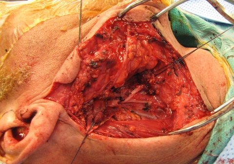 Sutures distracted segments of digastric and stylohyoid muscles that were severed at their midportion to improve access to the parapharyngeal space