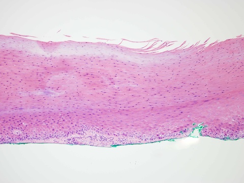 This biopsy shows thick parakeratosis as well as some atypia along the basal zone sufficient for a diagnosis of mild squamous dysplasia