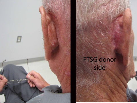 0170 FTSG 3 mo fu.jpg