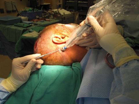"In vivo" 10 second count with gamma probe is recorded as 40,447 on grid (see last photo). "In vivo" refers to evaluation with the node exposed through the incision.