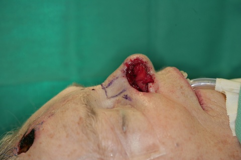 1st Stage Intraop-Septal Hinge flap sutured in place 