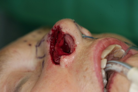 1st Stage Intraop-Basal view of Septal Hinge Flap 