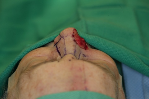 1st Stage Intraop-Conchal Cartilage graft-Superior view
