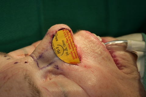 1st Stage Intraop-Forehead flap template 