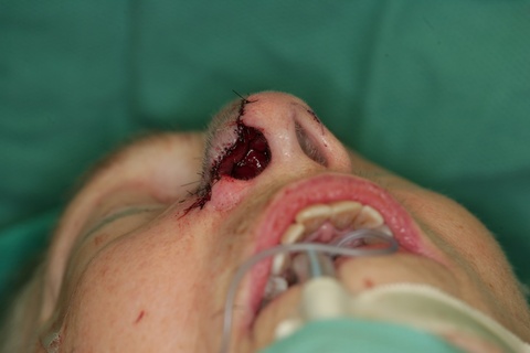 1st Stage Intraop-Forehead flap inset-Basal view 