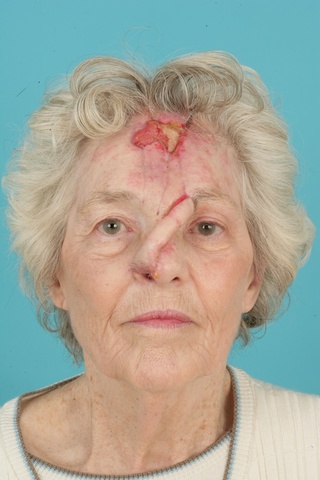 3 weeks post 1st stage-Anterior view 