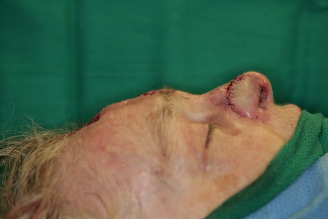 Intraop 2nd stage-Flap inset into nose-Lateral view
