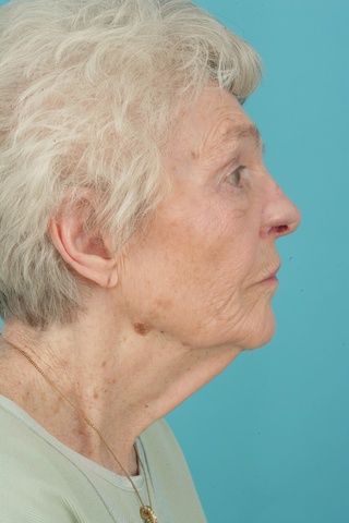 5 month postop-Lateral view