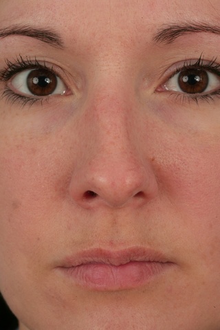 Close Up Preop