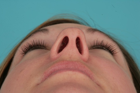 Nasal Base Preop