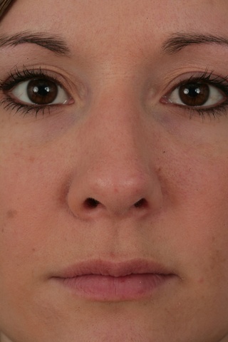 Close up Postop