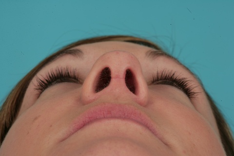 Nasal Base Postop
