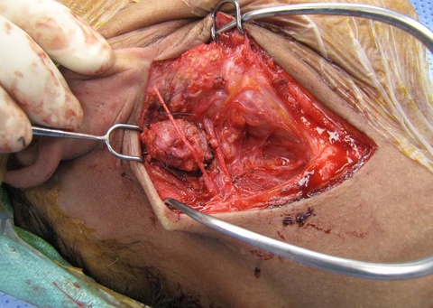 great auricular nerve is dissected free without compromising margins