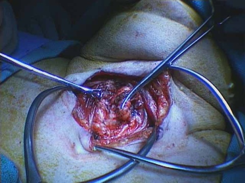 A large portion of the midline thyroid is removed and sent for pathologic assessment (permanent section)