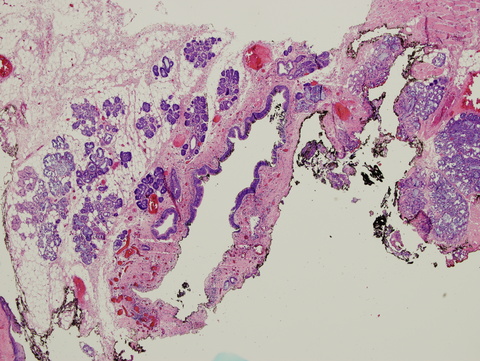 027%20Laryngocele2%2040x.jpg