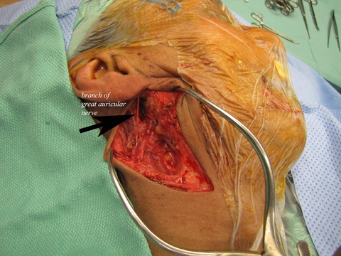 resection complete with preservation of great auricular nerve
