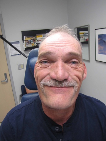 POD#8 with facial nerve function intact