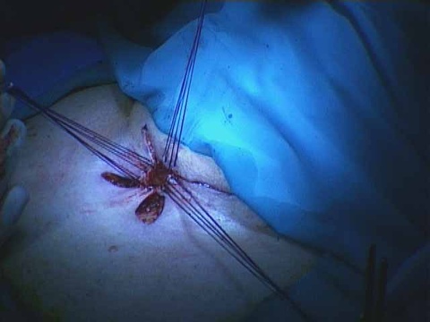 040%20trachstenosis.jpg