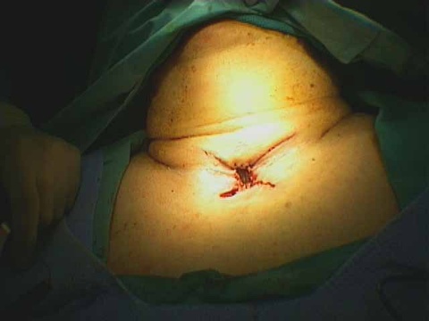 041%20trachstenosis.jpg