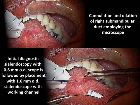 042%20foreing%20body%20sialendoscopy.jpg
