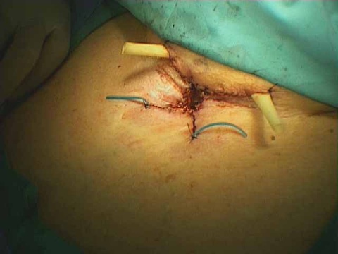 043%20trachstenosis.jpg