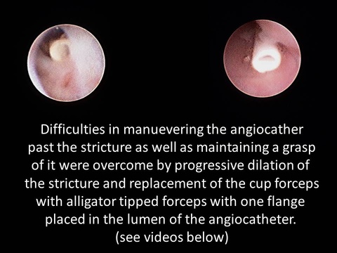 046%20foreing%20body%20sialendoscopy.jpg