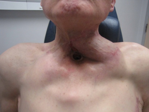 Followup 0207029 after Left PMC (myocutaneous) flap (1-13-2012) and Right PMF (myofascial) flap (12-15-10)