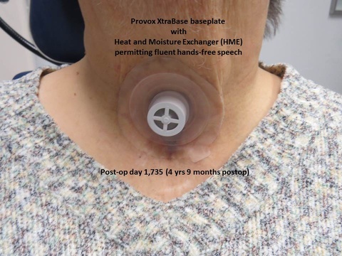 061%20epi%20trach.JPG