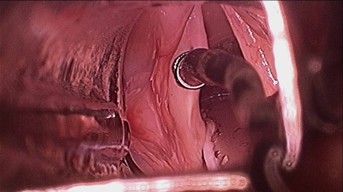 Intraoperative - resection of left vocal fold leukoplakia