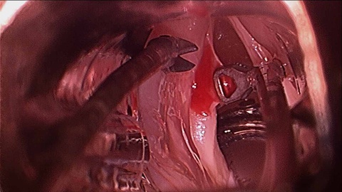 Intraoperative - resection of left vocal fold leukoplakia