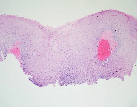 While this biopsy from the posterior portion of the left vocal cord is superficial, it shows disordered architecture and mild cytologic atypia confined to the lower third of the mucosa, warranting a diagnosis of mild squamous dysplasia.