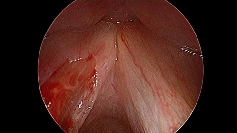 Intraoperative - resection of left vocal fold leukoplakia