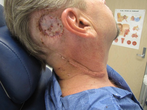 Post-op day 10 after skin graft and posterolateral neck dissection