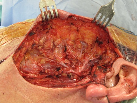 10%20parotid.jpg