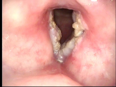 2013 April 26:  Microdirect laryngoscopy with more extensive resection: pathology = squamous cell carcinoma in situ (cis) right anterior, mid and posterior vocal cord; invasive to 0.1 cm (1mm) squamous cell carcinoma arising in a background of cis along t