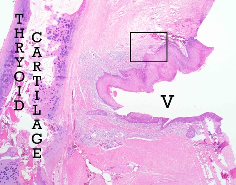    Low magnification of supracricoid laryngectomy show thyroid cartilage (left), ventricle (V), and extensive squamous cell carcinoma in situ with focal invasion (black box) magnified on next photomicrograph 