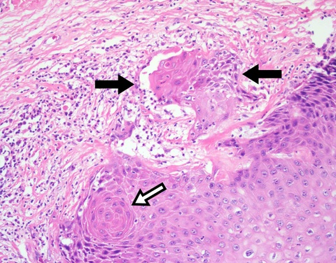 Intermediate magnification of designated area showing an irregular, invasive nest (black arrows) in the superficial submucosa and a deep keratin pearl (white arrow).