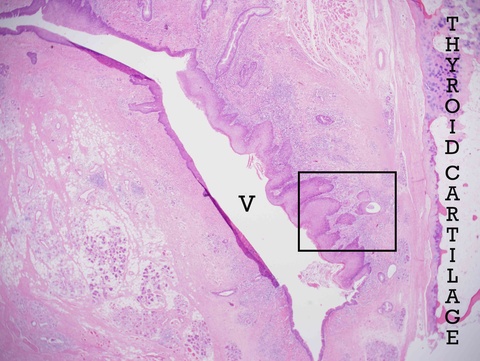 Low magnification of another area of the supracricoid laryngectomy with thyroid cartilage (right), ventricle (V), and a focus of invasive carcinoma arising in obviously atypical mucosa (black box) which is magnified in the next photomicrograph.