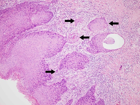 Intermediate magnification of boxed area showing infiltrating, irregular nests (black arrows) extending into the superficial submucosa (<0.1 cm depth of invasion).