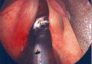 August 2006 laryngoscopy resection with botox 15 units left TA