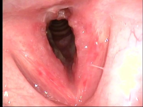 Transnasal fiberoptic laryngoscopy at UIHC 08/13/10 (day 4 of prednisone)