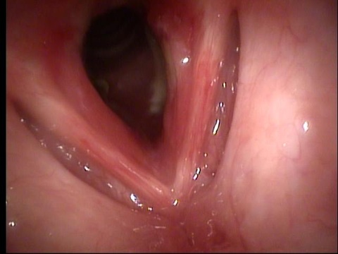 Transnasal fiberoptic laryngoscopy at UIHC 08/17/10 (day 8 of prednisone)