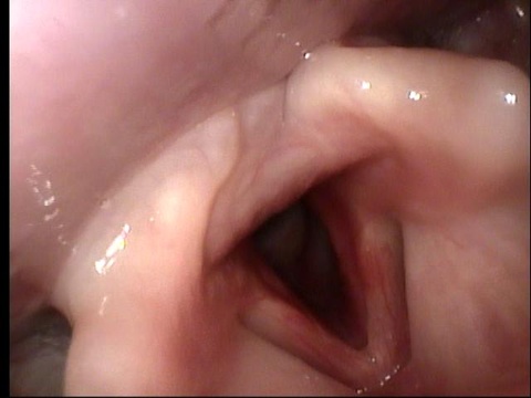 Transnasal fiberoptic laryngoscopy at UIHC 08/31/10 (day 22 of prednisone)