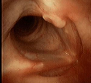 Sept 2006 4 weeks postop breathy voice