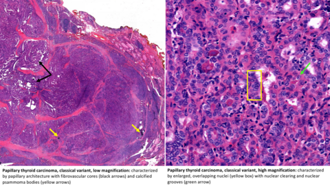 Papillary thyroid carcinoma, classical, low magnification (left) and high magnification (right). Papillary thyroid carcinoma, classical, low magnification (left) and high magnification (right).