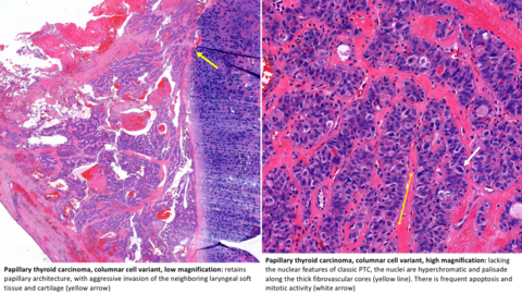 Papillary thyroid carcinoma, columnar cell variant, low magnification (left) and high magnification (right) Papillary thyroid carcinoma, columnar cell variant, low magnification (left) and high magnification (right)
